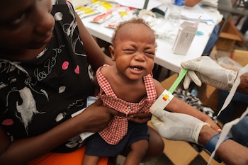 Un enfant malnutri est examiné