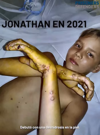 Un jeune garçon, Jonathan David Muir, avec la peau des bras et des mains jaunie et avec des ulcères ou des ampoules. Une partie de son torse est visible avec des taches. fond clair