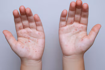Les épidémies de rougeole au Mexique et au Guatemala sont liées au déclin de la couverture vaccinale et à l’impact des mouvements anti-vaccins. (Photo : avec l'aimable autorisation)